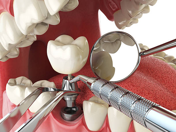 Best Emergency Denture Repair in Solvang, CA